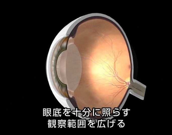 散瞳検査3