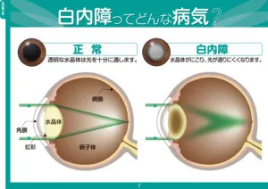 白内障