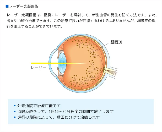 レーザー光凝固術