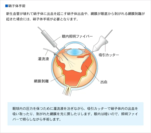 硝子体